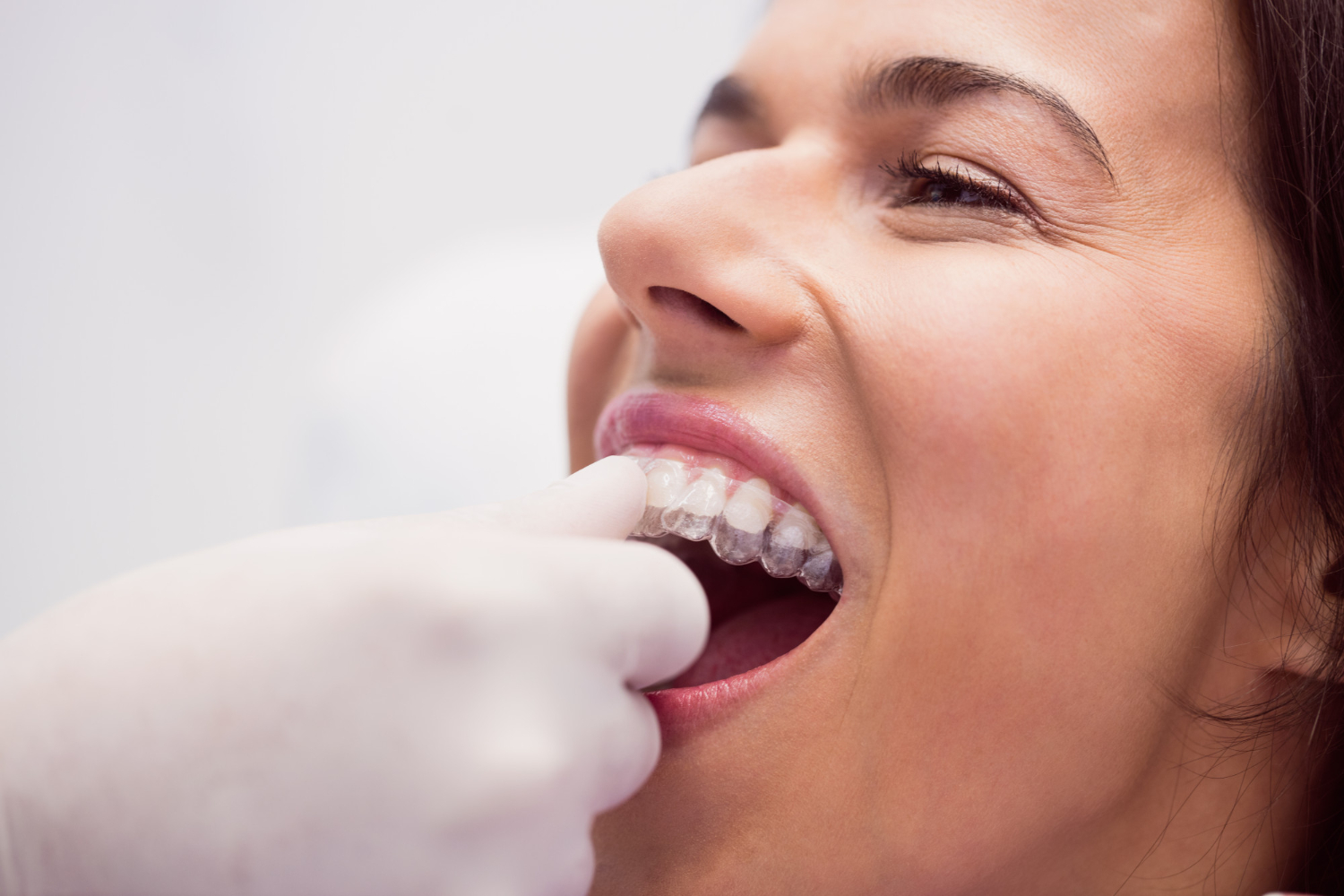 Clear Aligner Treatment