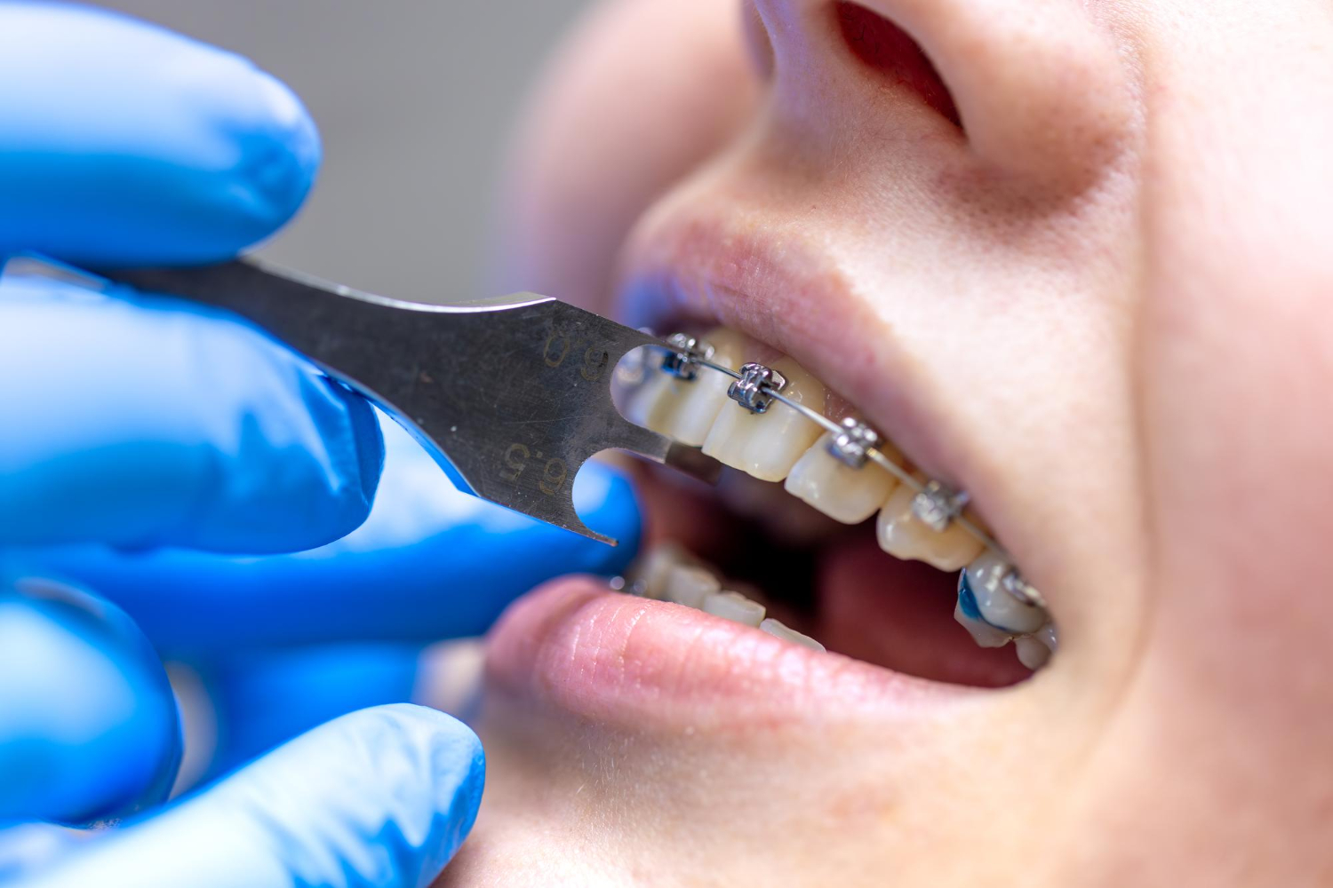 Conventional Orthodontics